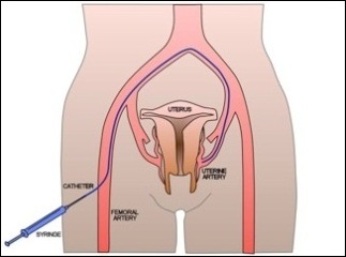 Fibroid Embolisation Schematic Oxford Interventional Radiology