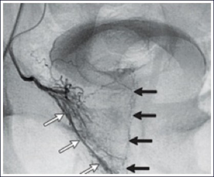 Prostate Artery Embolisation Oxford Interventional Radiology